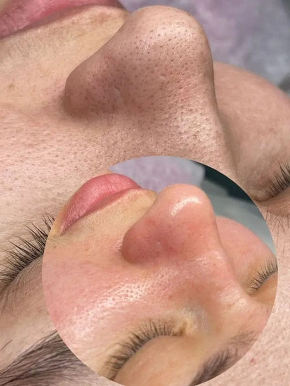 Epurateur de visage- lifting visage