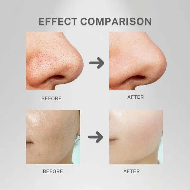 Epurateur de visage- lifting visage